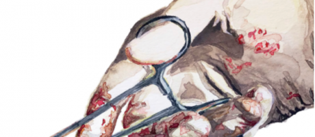 [:it]L’etica nella medicina moderna.  Adenocarcinoma del pancreas: cosa c’è di nuovo? Metastasi epatiche non colo-rettali[:]